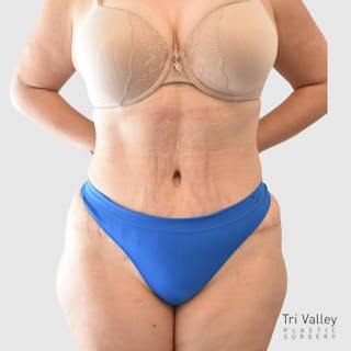 Mommy Makeover Before & After Gallery - Patient 426684 - Image 2