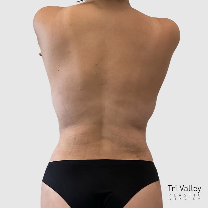 Liposuction Before & After Gallery - Patient 255664 - Image 4