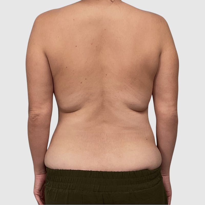 Liposuction Before & After Gallery - Patient 255664 - Image 3