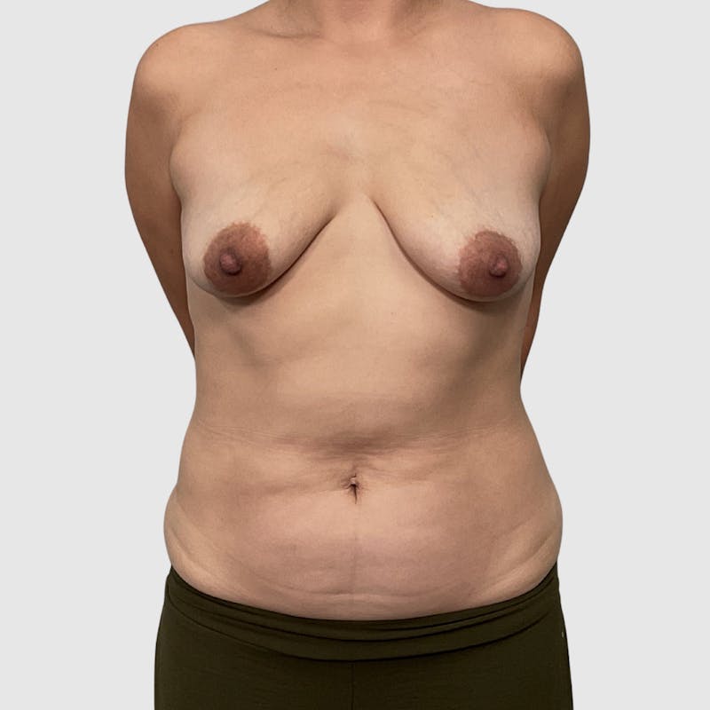 Liposuction Before & After Gallery - Patient 255664 - Image 1