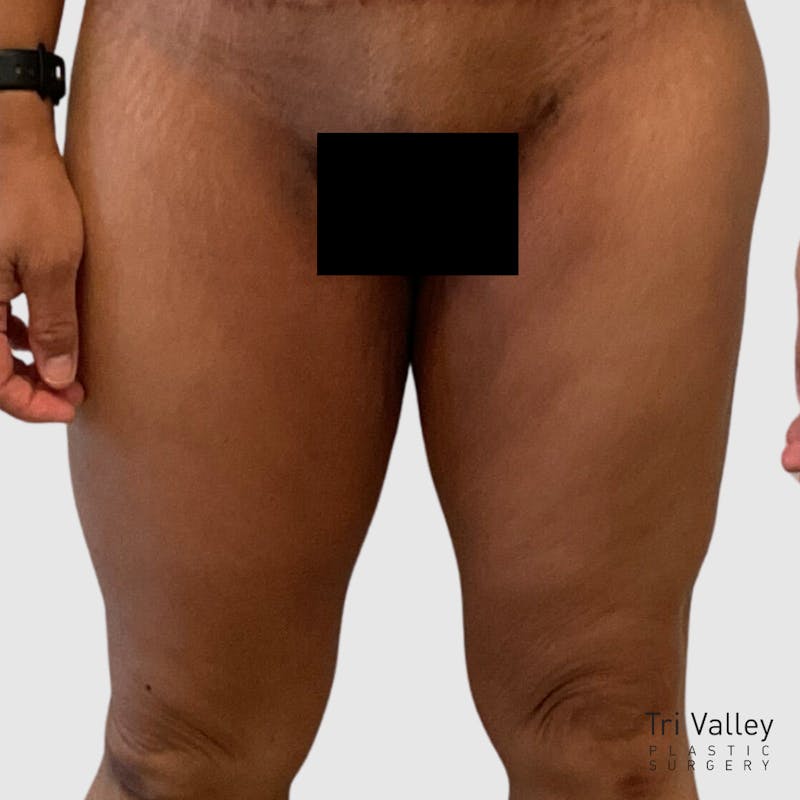 Thigh Lift Before & After Gallery - Patient 123724 - Image 2