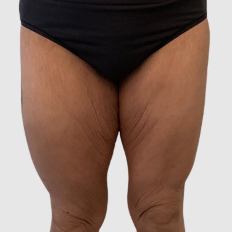 Thigh Lift Before & After Gallery - Patient 123724 - Image 1