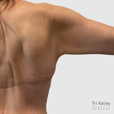 Brachioplasty Before & After Gallery - Patient 853094 - Image 2