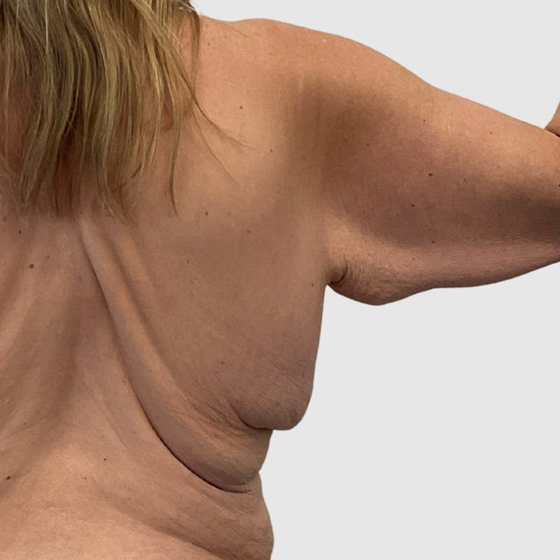 Brachioplasty Before & After Gallery - Patient 853094 - Image 1