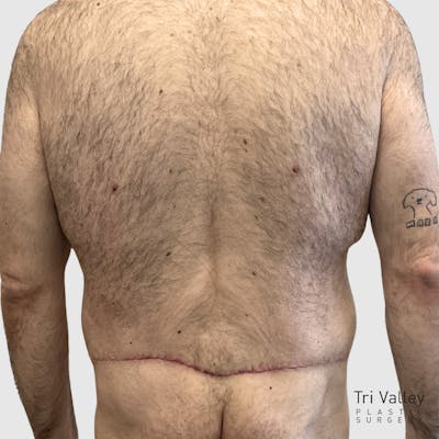Body Lift Before & After Gallery - Patient 147850 - Image 2