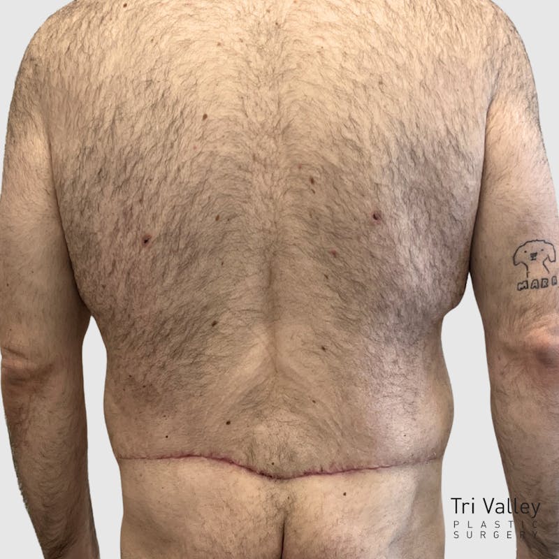Body Lift Before & After Gallery - Patient 147850 - Image 2