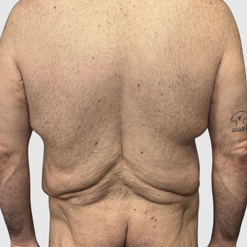 Body Lift Before & After Gallery - Patient 147850 - Image 1