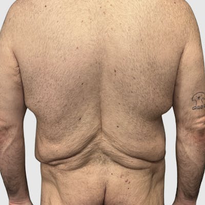 Body Lift Before & After Gallery - Patient 147850 - Image 1