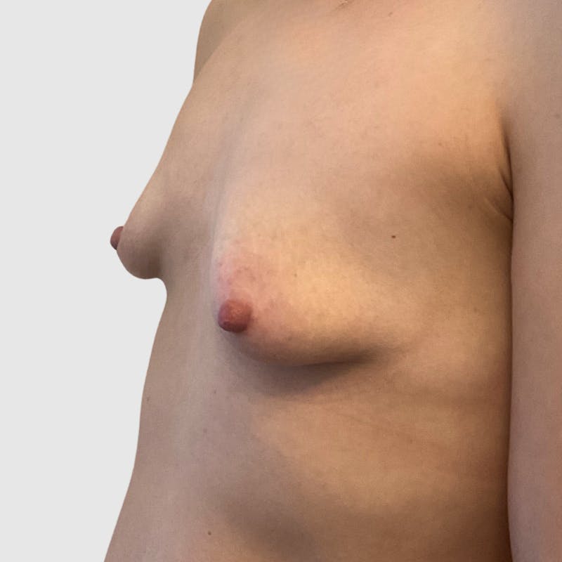 Breast Augmentation Before & After Gallery - Patient 337181 - Image 3