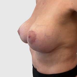 Breast Lift Before & After Gallery - Patient 320074 - Image 4