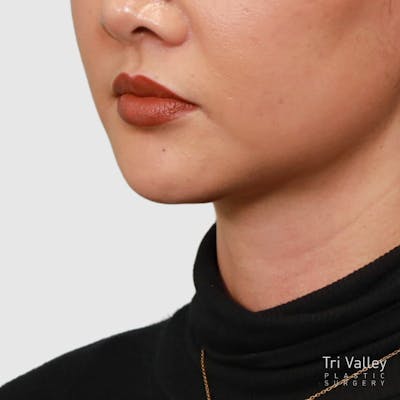 Face and Neck Lifts Before & After Gallery - Patient 297022 - Image 2