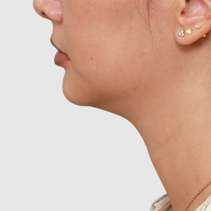Face and Neck Lifts Before & After Gallery - Patient 297022 - Image 3