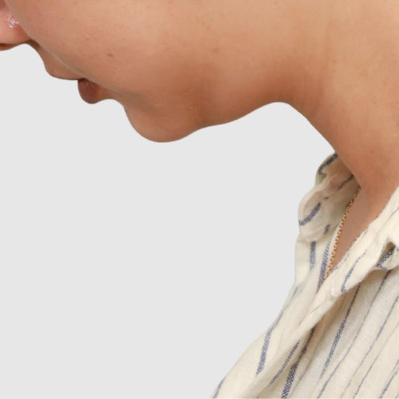 Face and Neck Lifts Before & After Gallery - Patient 297022 - Image 5