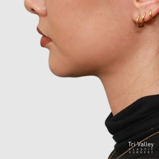 Face and Neck Lifts Before & After Gallery - Patient 297022 - Image 4