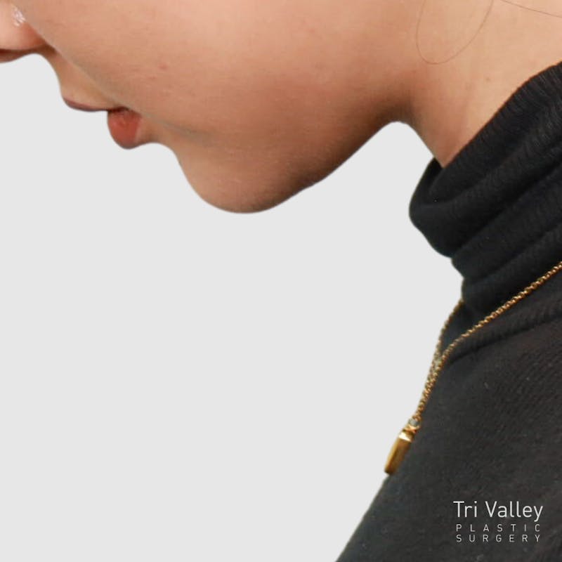 Face and Neck Lifts Before & After Gallery - Patient 297022 - Image 6