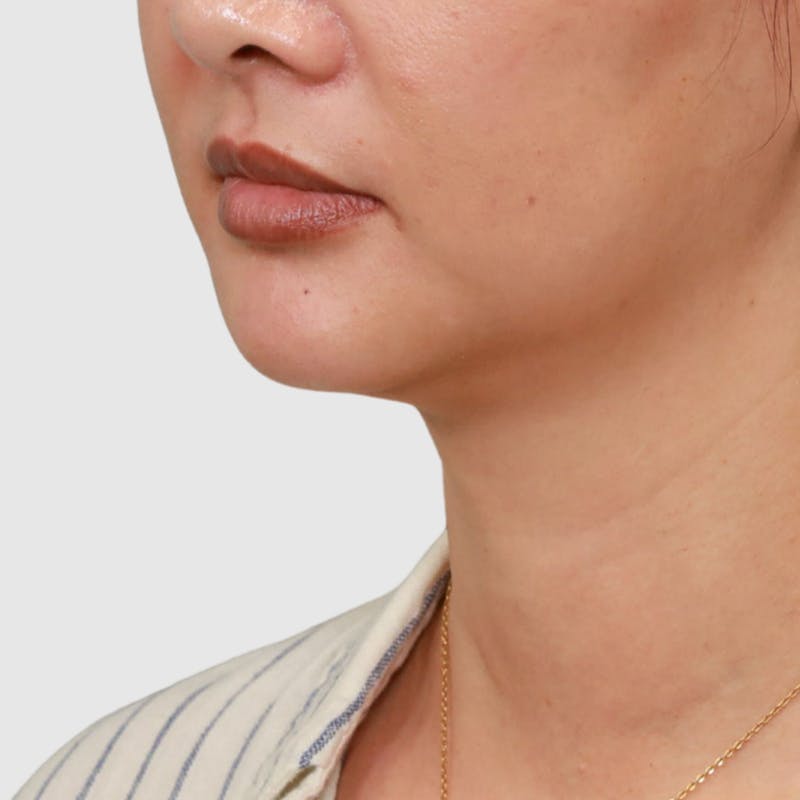 Face and Neck Lifts Before & After Gallery - Patient 297022 - Image 1