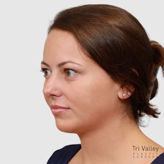 Chin Augmentation Before & After Gallery - Patient 388854 - Image 6