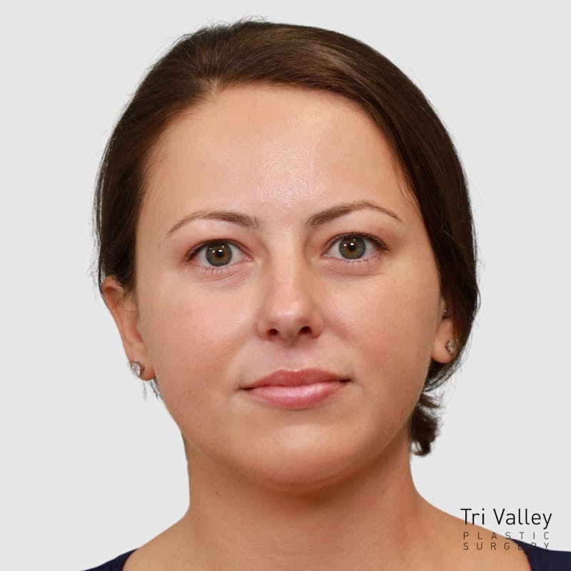 Chin Augmentation Before & After Gallery - Patient 388854 - Image 8