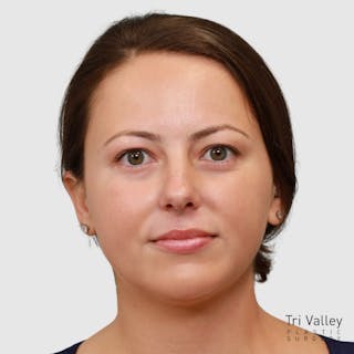 Chin Augmentation Before & After Gallery - Patient 388854 - Image 8