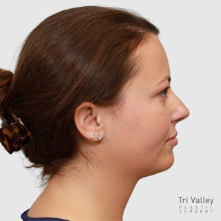 Chin Augmentation Before & After Gallery - Patient 388854 - Image 4