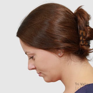 Face and Neck Lifts Before & After Gallery - Patient 391726 - Image 8