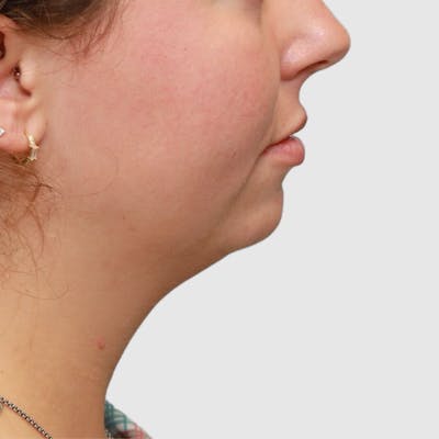 Chin Augmentation Before & After Gallery - Patient 388854 - Image 1