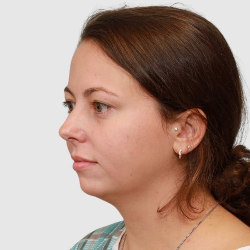 Chin Augmentation Before & After Gallery - Patient 388854 - Image 5