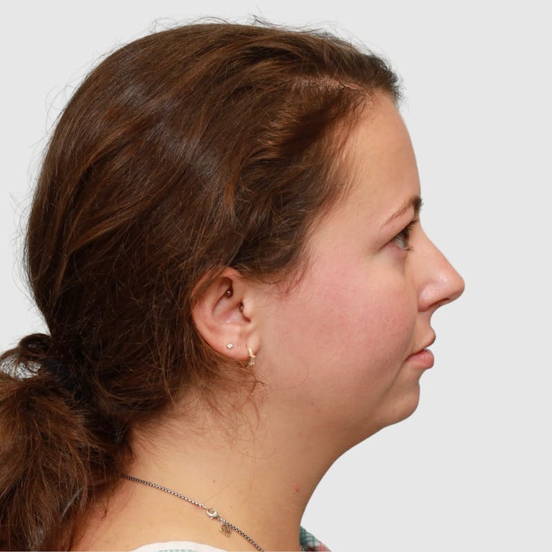 Chin Augmentation Before & After Gallery - Patient 388854 - Image 3