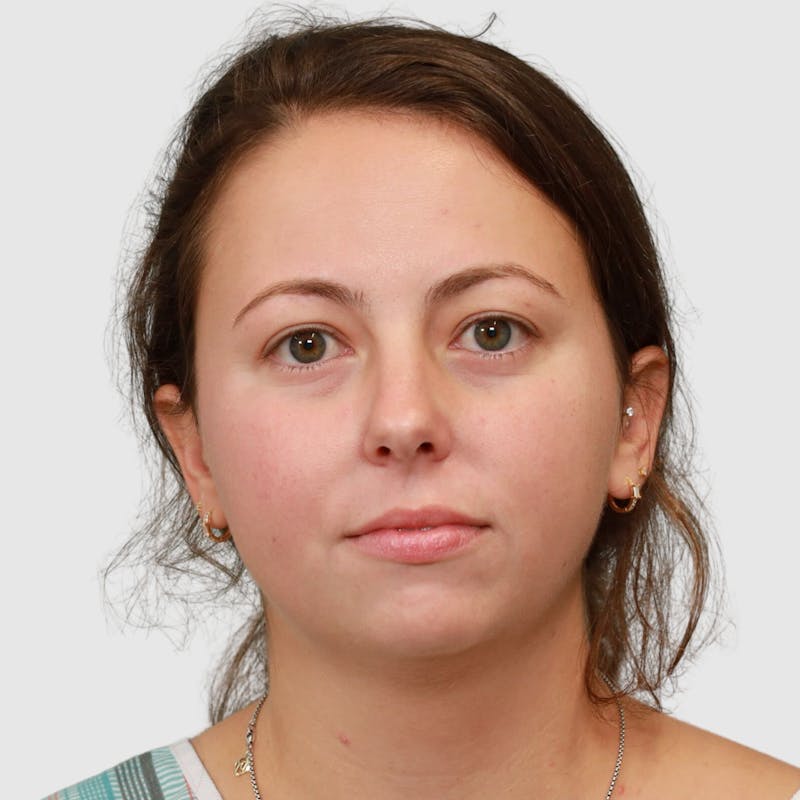 Chin Augmentation Before & After Gallery - Patient 388854 - Image 7