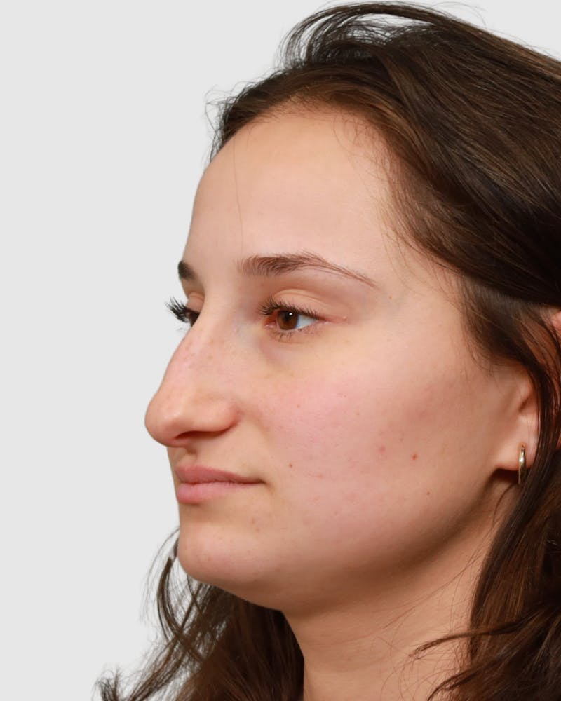 Rhinoplasty Before & After Gallery - Patient 688516 - Image 3
