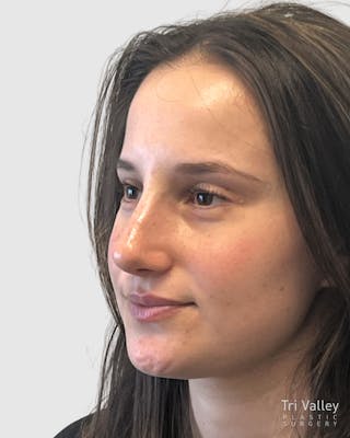 Rhinoplasty Before & After Gallery - Patient 688516 - Image 4