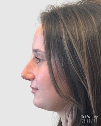 Rhinoplasty Before & After Gallery - Patient 688516 - Image 2