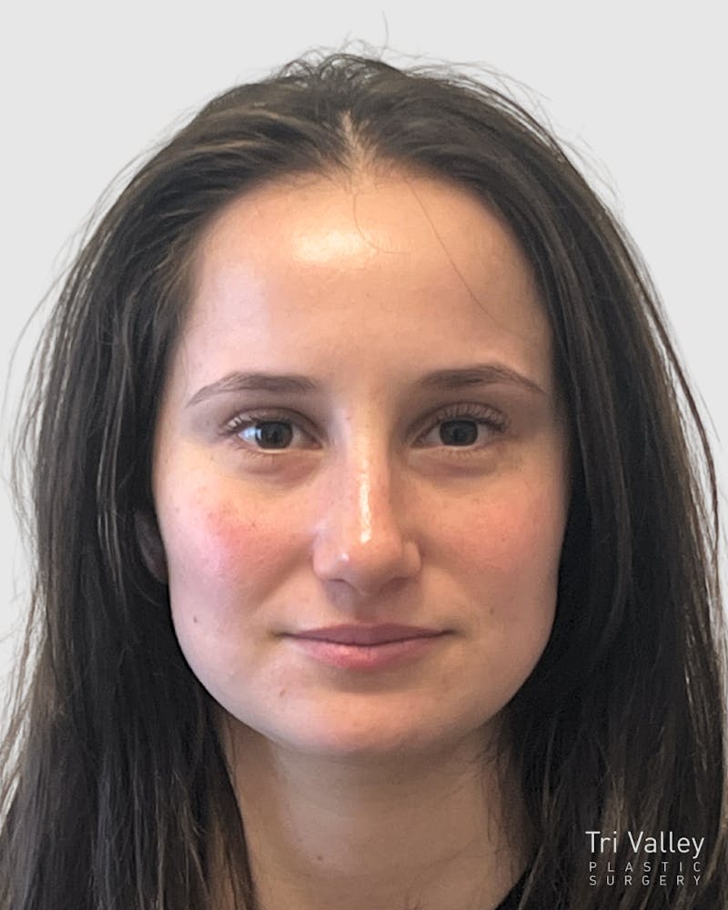 Rhinoplasty Before & After Gallery - Patient 688516 - Image 6