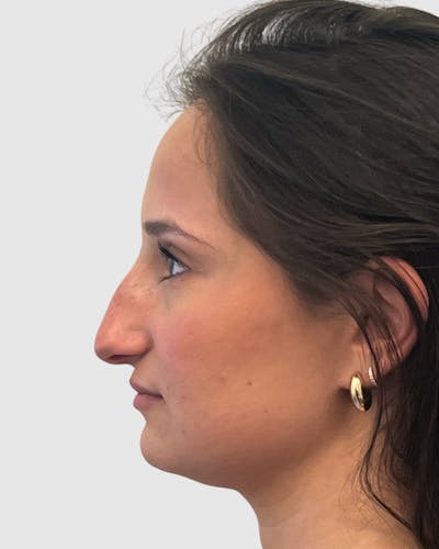 Rhinoplasty Before & After Gallery - Patient 688516 - Image 1