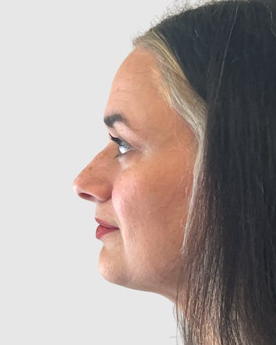 Rhinoplasty Before & After Gallery - Patient 152331 - Image 1
