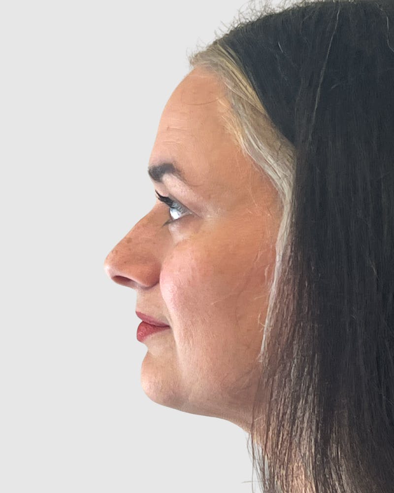 Rhinoplasty Before & After Gallery - Patient 152331 - Image 1