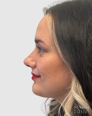 Rhinoplasty Before & After Gallery - Patient 152331 - Image 2