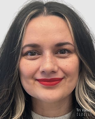 Rhinoplasty Before & After Gallery - Patient 152331 - Image 4