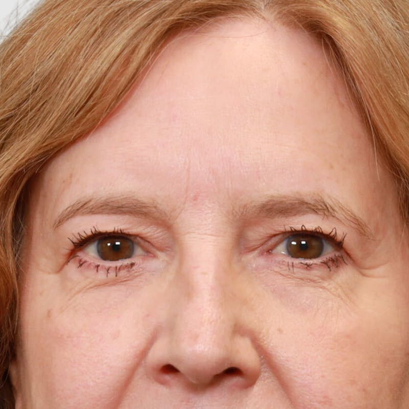 Blepharoplasty Before & After Gallery - Patient 257779 - Image 1