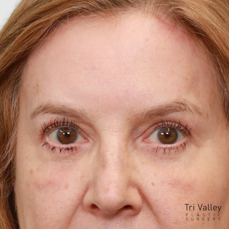 Blepharoplasty Before & After Gallery - Patient 257779 - Image 2