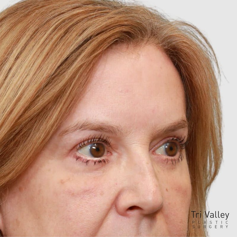 Blepharoplasty Before & After Gallery - Patient 257779 - Image 4