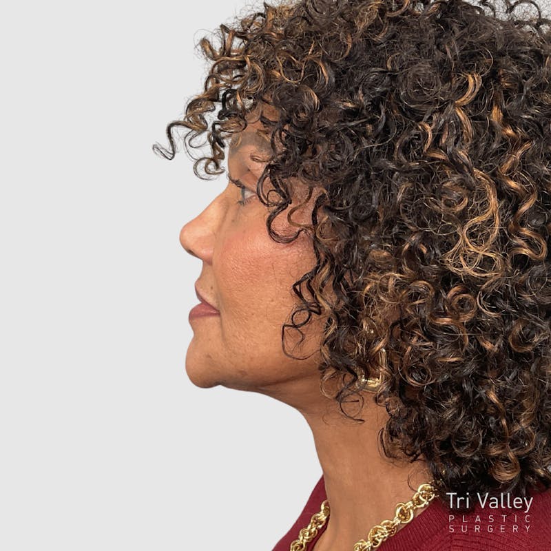 Laser Skin Resurfacing Before & After Gallery - Patient 210606 - Image 4