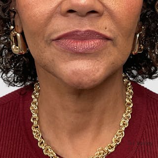 Laser Skin Resurfacing Before & After Gallery - Patient 210606 - Image 6