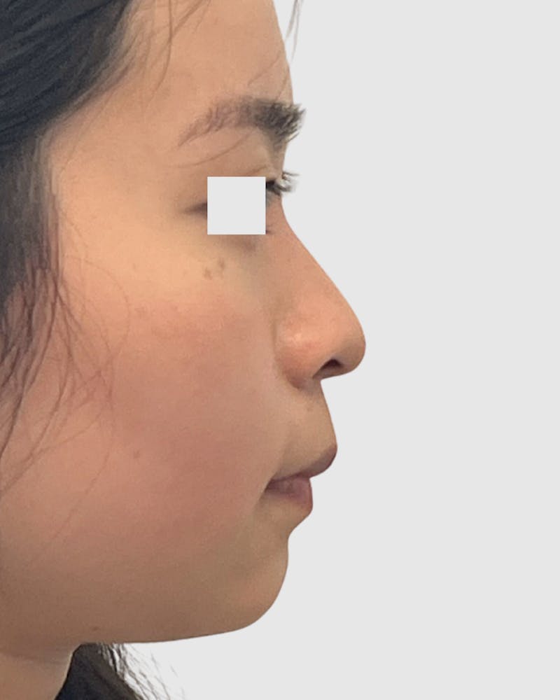 Rhinoplasty Before & After Gallery - Patient 166807 - Image 1