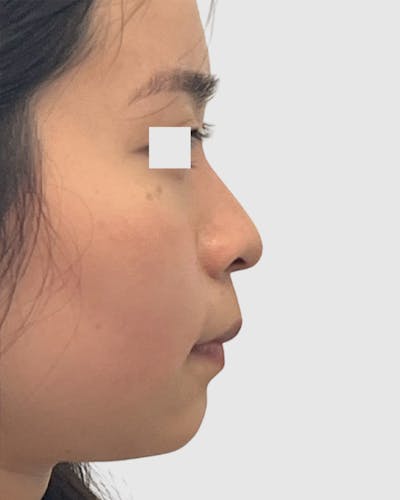 Rhinoplasty Before & After Gallery - Patient 166807 - Image 1