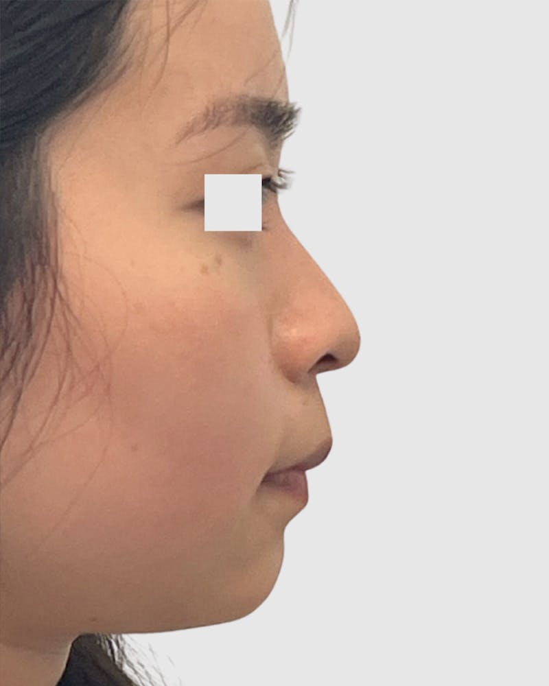 Rhinoplasty Before & After Gallery - Patient 166807 - Image 1