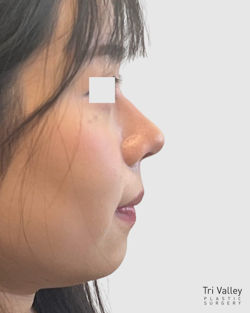 Rhinoplasty Before & After Gallery - Patient 166807 - Image 2