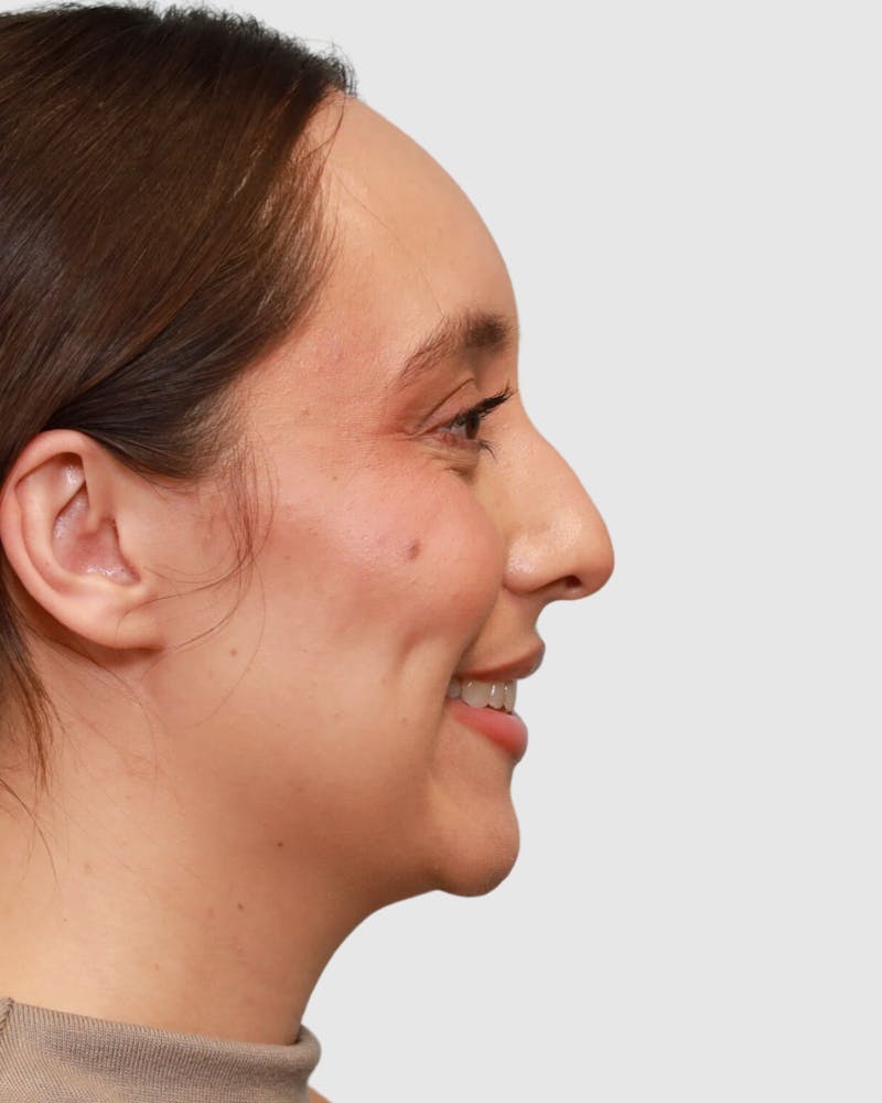 Rhinoplasty Before & After Gallery - Patient 204021 - Image 1