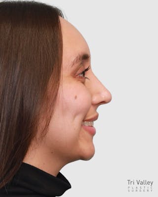 Rhinoplasty Before & After Gallery - Patient 204021 - Image 2