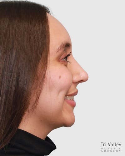 Rhinoplasty Before & After Gallery - Patient 204021 - Image 2